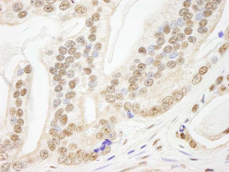 Detection of Human Pds5B by Immunohistochemistry. Sample: FFPE section of human prostate carcinoma. Antibody: Affinity purified rabbit anti-Pds5B used at a dilution of 1:250.