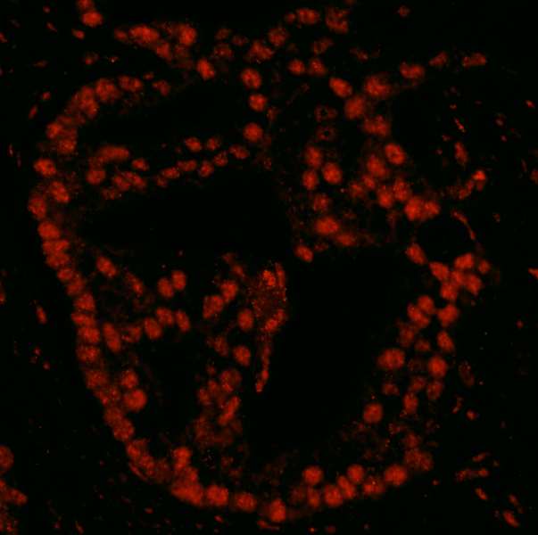 Detection of Human Pds5B by IHC-IF. Sample: FFPE section of human prostate carcinoma. Antibody: Affinity purified rabbit anti-Pds5B used at a dilution of 1:100. Detection: Red-fluorescent goat anti-rabbit IgG highly cross-adsorbed Antibody Hilyte Plus 555 (A120-501E) used at a dilution of 1:100.