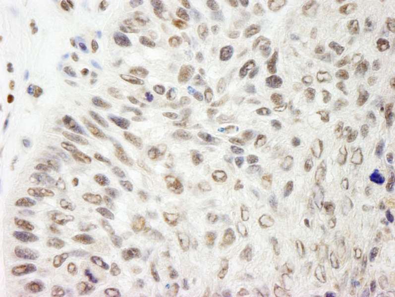 Detection of Human Pds5B by Immunohistochemistry. Sample: FFPE section of human laryngeal squamous cell carcinoma. Antibody: Affinity purified rabbit anti-Pds5B used at a dilution of 1:200 (1 ug/ml). Detection: DAB.