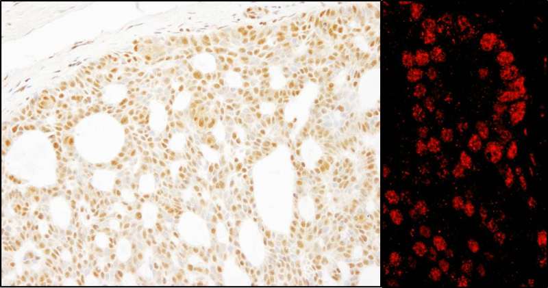 Detection of Human Pds5B by Immunohistochemistry and Immunofluorescence. Sample: FFPE sections of human skin carcinoma (left) and prostate carcinoma (right). Antibody: Affinity purified rabbit anti-Pds5B used at a dilution of 1:200 (1 ug/ml) and 1:80 (2.5 ug/ml). Detection: DAB and Red-fluorescent Goat anti-Rabbit IgG-heavy and light chain, cross-adsorbed Antibody DyLight 594 Conjugated used at a dilution of 1:100.