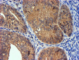 IHC of paraffin-embedded Adenocarcinoma of Human endometrium tissue using anti-PDSS2 mouse monoclonal antibody.