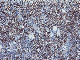 IHC of paraffin-embedded Human lymphoma tissue using anti-PDSS2 mouse monoclonal antibody.