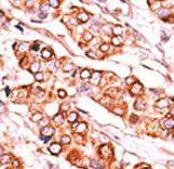 Formalin-fixed and paraffin-embedded human cancer tissue reacted with the primary antibody, which was peroxidase-conjugated to the secondary antibody, followed by DAB staining. This data demonstrates the use of this antibody for immunohistochemistry; clinical relevance has not been evaluated. BC = breast carcinoma; HC = hepatocarcinoma.