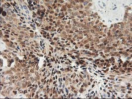 IHC of paraffin-embedded Adenocarcinoma of Human breast tissue using anti-PDXK mouse monoclonal antibody.