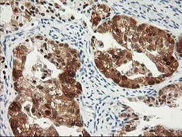IHC of paraffin-embedded Adenocarcinoma of Human ovary tissue using anti-PDXK mouse monoclonal antibody.