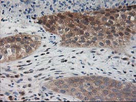 IHC of paraffin-embedded Carcinoma of Human bladder tissue using anti-PDXK mouse monoclonal antibody.