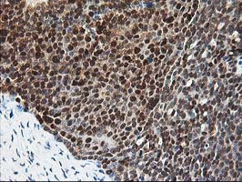 IHC of paraffin-embedded Adenocarcinoma of Human ovary tissue using anti-PDXK mouse monoclonal antibody.