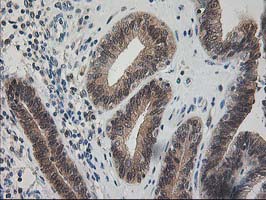 IHC of paraffin-embedded Adenocarcinoma of Human endometrium tissue using anti-PDXK mouse monoclonal antibody.