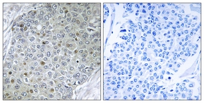 IHC of paraffin-embedded human breast carcinoma tissue, using ETV4 Antibody. The picture on the right is treated with the synthesized peptide.