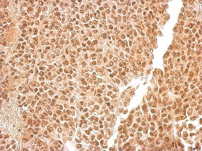 PEA3 antibody detects ETV4 protein at cytosol and nucleus on BT483 xenograft by immunohistochemical analysis. Sample: Paraffin-embedded BT483 xenograft. PEA3 antibody dilution: 1:500.