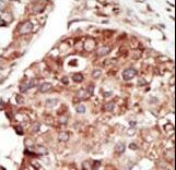 Formalin-fixed and paraffin-embedded human cancer tissue reacted with the primary antibody, which was peroxidase-conjugated to the secondary antibody, followed by DAB staining. This data demonstrates the use of this antibody for immunohistochemistry; clinical relevance has not been evaluated. BC = breast carcinoma; HC = hepatocarcinoma.
