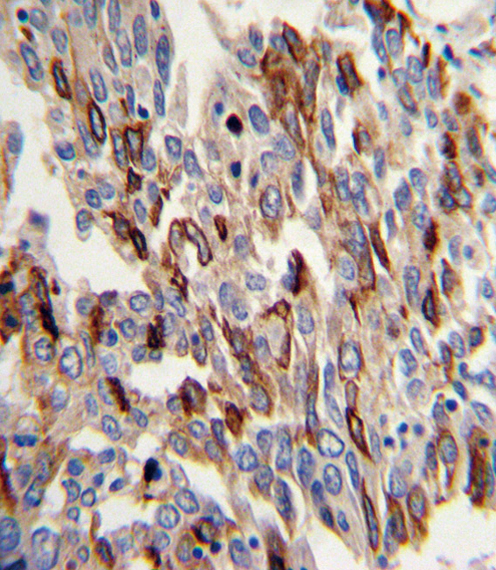 Formalin-fixed and paraffin-embedded human lung carcinoma with CD31 Antibody , which was peroxidase-conjugated to the secondary antibody, followed by DAB staining. This data demonstrates the use of this antibody for immunohistochemistry; clinical relevance has not been evaluated.