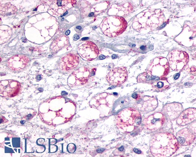 Anti-MCHR1 antibody IHC of human Soft Tissue, Liposarcoma. Immunohistochemistry of formalin-fixed, paraffin-embedded tissue after heat-induced antigen retrieval.