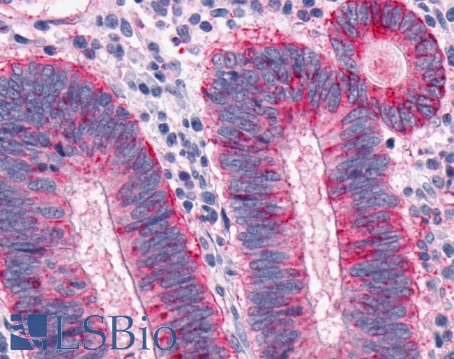 Anti-MCHR1 antibody IHC of human Colon, Carcinoma. Immunohistochemistry of formalin-fixed, paraffin-embedded tissue after heat-induced antigen retrieval.