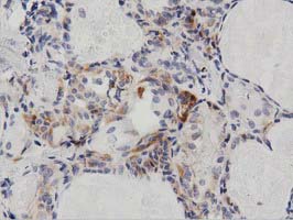 IHC of paraffin-embedded Carcinoma of Human thyroid tissue using anti-PECR mouse monoclonal antibody. (Dilution 1:50).
