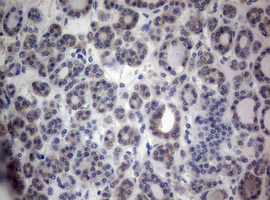 IHC of paraffin-embedded Carcinoma of Human thyroid tissue using anti-PEG3 mouse monoclonal antibody.