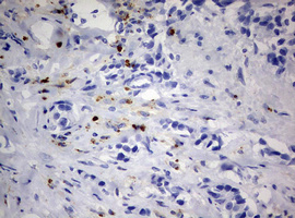 IHC of paraffin-embedded Adenocarcinoma of Human breast tissue using anti-PEG3 mouse monoclonal antibody.