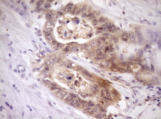 IHC of paraffin-embedded Adenocarcinoma of Human colon tissue using anti-PELI1 mouse monoclonal antibody. (Heat-induced epitope retrieval by Tris-EDTA, pH8.0)(1:150).