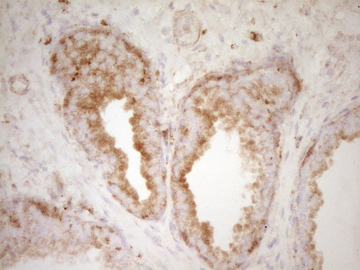 IHC of paraffin-embedded Carcinoma of Human prostate tissue using anti-PELI1 mouse monoclonal antibody. (Heat-induced epitope retrieval by 1 mM EDTA in 10mM Tris, pH8.5, 120°C for 3min).