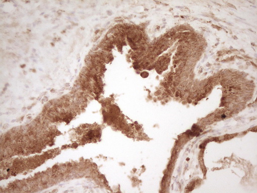 IHC of paraffin-embedded Adenocarcinoma of Human endometrium tissue using anti-PELI1 mouse monoclonal antibody. (Heat-induced epitope retrieval by 1 mM EDTA in 10mM Tris, pH8.5, 120°C for 3min).