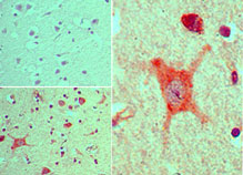 IHC of PER2 in formalin-fixed, paraffin-embedded human brain tissue using an isotype control (top left) and LS-C148562 (bottom left, right) at 5 ug/ml.