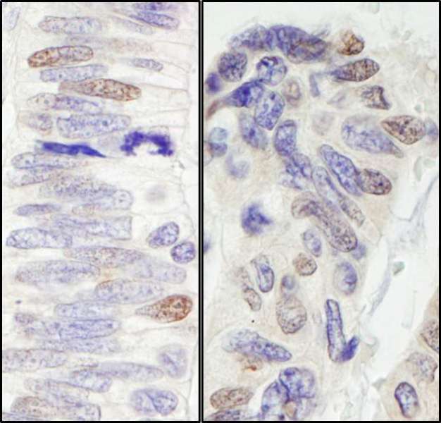 Detection of Human Pescadillo by Immunohistochemistry. Sample: FFPE sections of human colon carcinoma (left) and ovarian carcinoma (right). Antibody: Affinity purified rabbit anti-Pescadillo used at a dilution of 1:1000 (1 ug/ml). Detection: DAB.