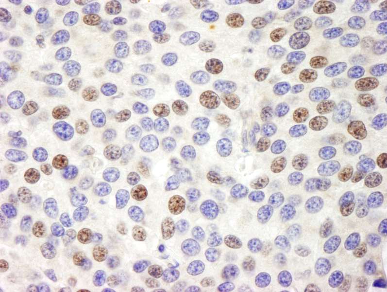 Detection of Human Pescadillo by Immunohistochemistry. Sample: FFPE section of human breast carcinoma. Antibody: Affinity purified rabbit anti-Pescadillo used at a dilution of 1:200 (1 ug/ml). Detection: DAB.