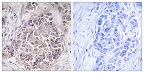 IHC of paraffin-embedded human breast carcinoma tissue, using PEX1 Antibody. The sample on the right was incubated with synthetic peptide.