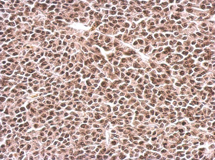 PFKFB3 antibody [C3], C-term detects PFKFB3 protein at nucleus on BT483 xenograft by immunohistochemical analysis. Sample: Paraffin-embedded BT483 xenograft. PFKFB3 antibody [C3], C-term dilution:1:500.