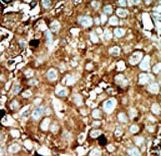 Formalin-fixed and paraffin-embedded human cancer tissue reacted with the primary antibody, which was peroxidase-conjugated to the secondary antibody, followed by AEC staining. This data demonstrates the use of this antibody for immunohistochemistry; clinical relevance has not been evaluated. BC = breast carcinoma; HC = hepatocarcinoma.