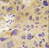 Formalin-fixed and paraffin-embedded human hepatocarcinoma tissue reacted with PFKFB1 antibody , which was peroxidase-conjugated to the secondary antibody, followed by DAB staining. This data demonstrates the use of this antibody for immunohistochemistry; clinical relevance has not been evaluated.