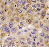 Formalin-fixed and paraffin-embedded human hepatocarcinoma tissue reacted with PFKFB1 antibody , which was peroxidase-conjugated to the secondary antibody, followed by DAB staining. This data demonstrates the use of this antibody for immunohistochemistry; clinical relevance has not been evaluated.