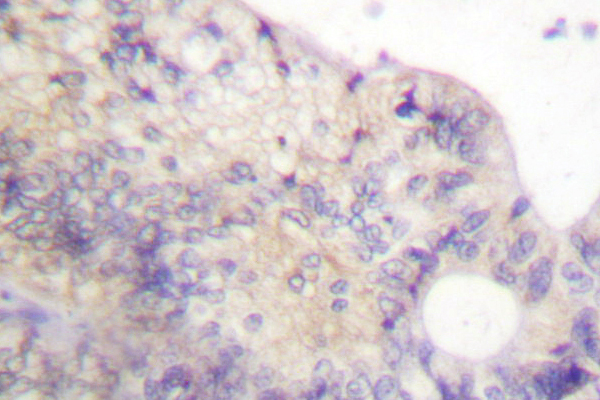 IHC of PFKFB2 (P479) pAb in paraffin-embedded human colon carcinoma tissue.