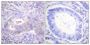 IHC of paraffin-embedded human colon carcinoma, using PFKFB2 (Phospho-Ser483) Antibody. The sample on the right was incubated with synthetic peptide.