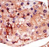 Formalin-fixed and paraffin-embedded human cancer tissue reacted with the primary antibody, which was peroxidase-conjugated to the secondary antibody, followed by DAB staining. This data demonstrates the use of this antibody for immunohistochemistry; clinical relevance has not been evaluated. BC = breast carcinoma; HC = hepatocarcinoma.