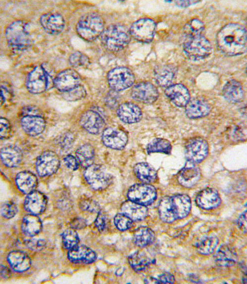 Formalin-fixed and paraffin-embedded human hepatocarcinoma tissue reacted with PFKFB4 antibody , which was peroxidase-conjugated to the secondary antibody, followed by DAB staining. This data demonstrates the use of this antibody for immunohistochemistry; clinical relevance has not been evaluated.