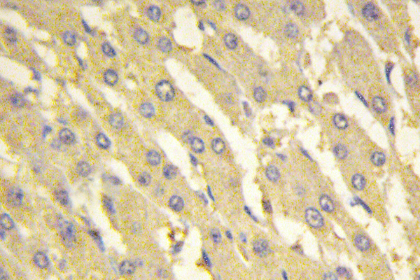 IHC of PFK-2 liv (E442) pAb in paraffin-embedded human liver carcinoma tissue.