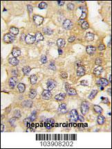 Formalin-fixed and paraffin-embedded human hepatocarcinoma tissue reacted with PFKM antibody , which was peroxidase-conjugated to the secondary antibody, followed by DAB staining. This data demonstrates the use of this antibody for immunohistochemistry; clinical relevance has not been evaluated.