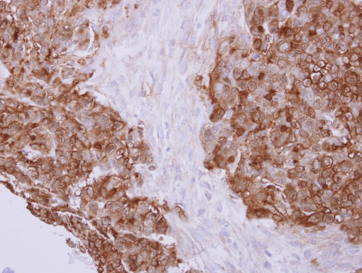 Profilin 2 antibody detects PFN2 protein at cytoplasm on colon carcinoma by immunohistochemical analysis. Sample: Paraffin-embedded colon carcinoma. Profilin 2 antibody dilution:1:500.