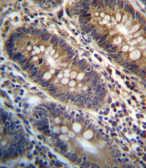 PGAP3 Antibody immunohistochemistry of formalin-fixed and paraffin-embedded human colon tissue followed by peroxidase-conjugated secondary antibody and DAB staining.
