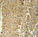 PGD Antibody immunohistochemistry of formalin-fixed and paraffin-embedded human lung carcinoma followed by peroxidase-conjugated secondary antibody and DAB staining.