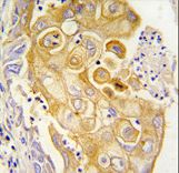 Formalin-fixed and paraffin-embedded human lung carcinoma tissue reacted with CYP8A1 antibody , which was peroxidase-conjugated to the secondary antibody, followed by DAB staining. This data demonstrates the use of this antibody for immunohistochemistry; clinical relevance has not been evaluated.