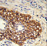 Formalin-fixed and paraffin-embedded human prostate carcinoma reacted with CYP8A1 Antibody , which was peroxidase-conjugated to the secondary antibody, followed by DAB staining. This data demonstrates the use of this antibody for immunohistochemistry; clinical relevance has not been evaluated.