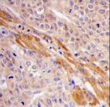 Formalin-fixed and paraffin-embedded human hepatocarcinoma tissue reacted with PGK1 Antibody (Center S320), which was peroxidase-conjugated to the secondary antibody, followed by DAB staining. This data demonstrates the use of this antibody for immunohistochemistry; clinical relevance has not been evaluated.