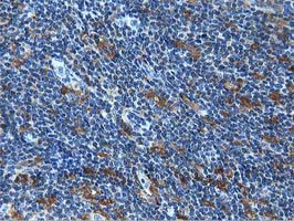 IHC of paraffin-embedded Human lymphoma tissue using anti-MICAL1 mouse monoclonal antibody.