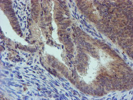 IHC of paraffin-embedded Adenocarcinoma of Human endometrium tissue using anti-PGM3 mouse monoclonal antibody.