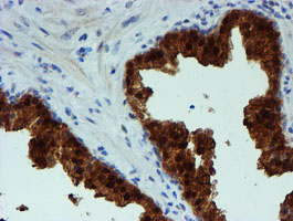 IHC of paraffin-embedded Carcinoma of Human prostate tissue using anti-PGM3 mouse monoclonal antibody.
