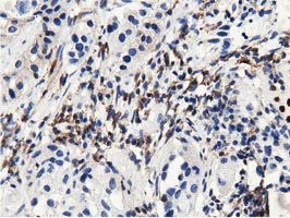 IHC of paraffin-embedded Carcinoma of Human bladder tissue using anti-MICAL1 mouse monoclonal antibody.
