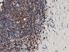 IHC of paraffin-embedded Human lymphoma tissue using anti-MICAL1 mouse monoclonal antibody.