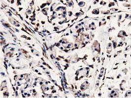 IHC of paraffin-embedded Adenocarcinoma of Human colon tissue using anti-MICAL1 mouse monoclonal antibody.